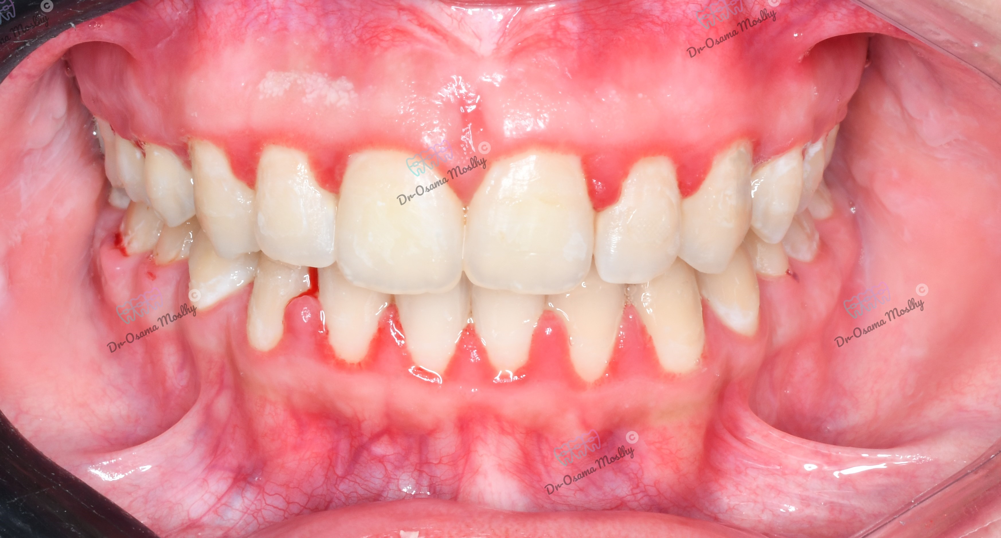 After علاج فلجة الأسنان العلوية (Midline Diastema) — Front view — تقويم — orthodontics Smouha