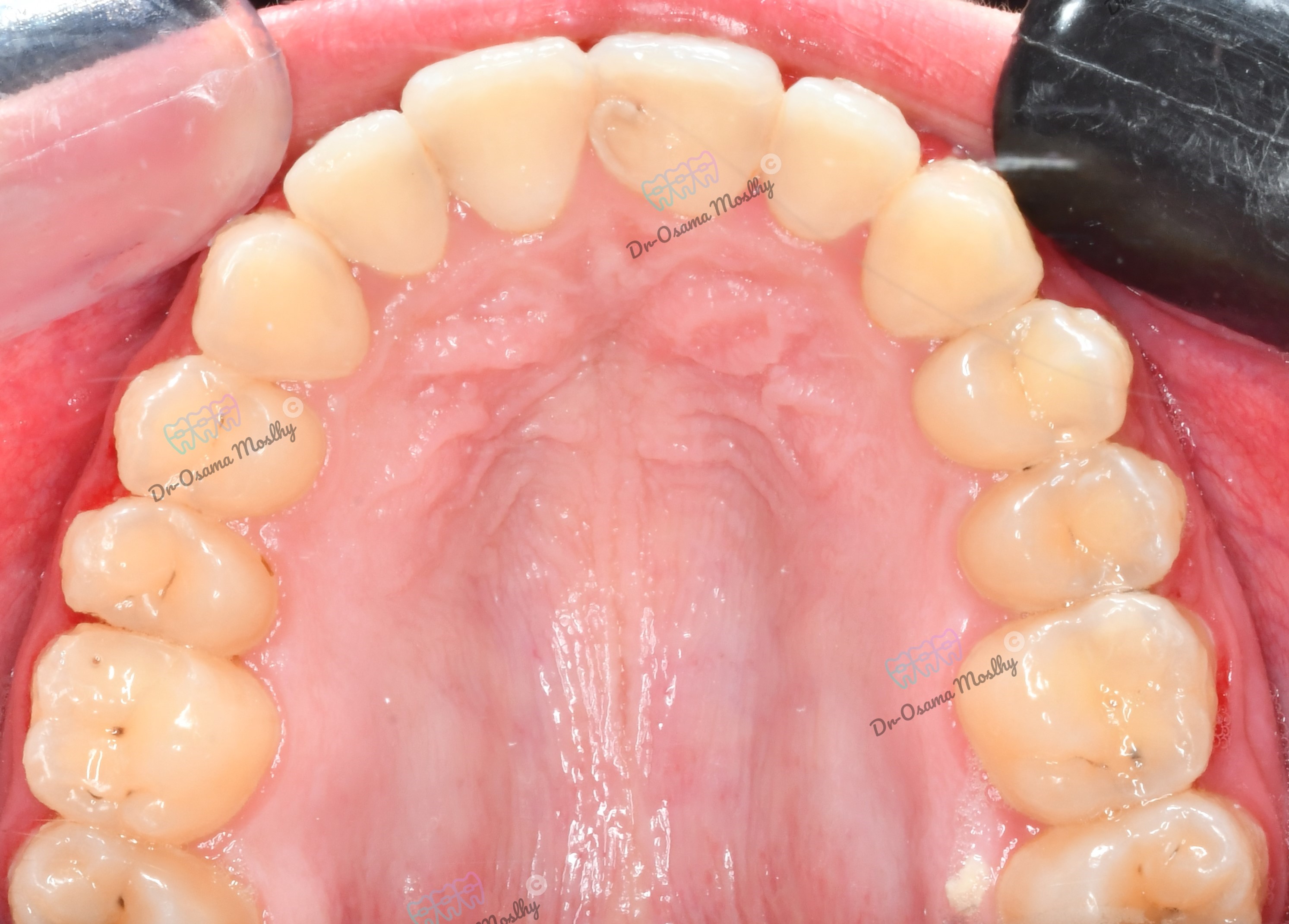 After علاج فلجة الأسنان العلوية (Midline Diastema) — Upper arch — تقويم — orthodontics Smouha