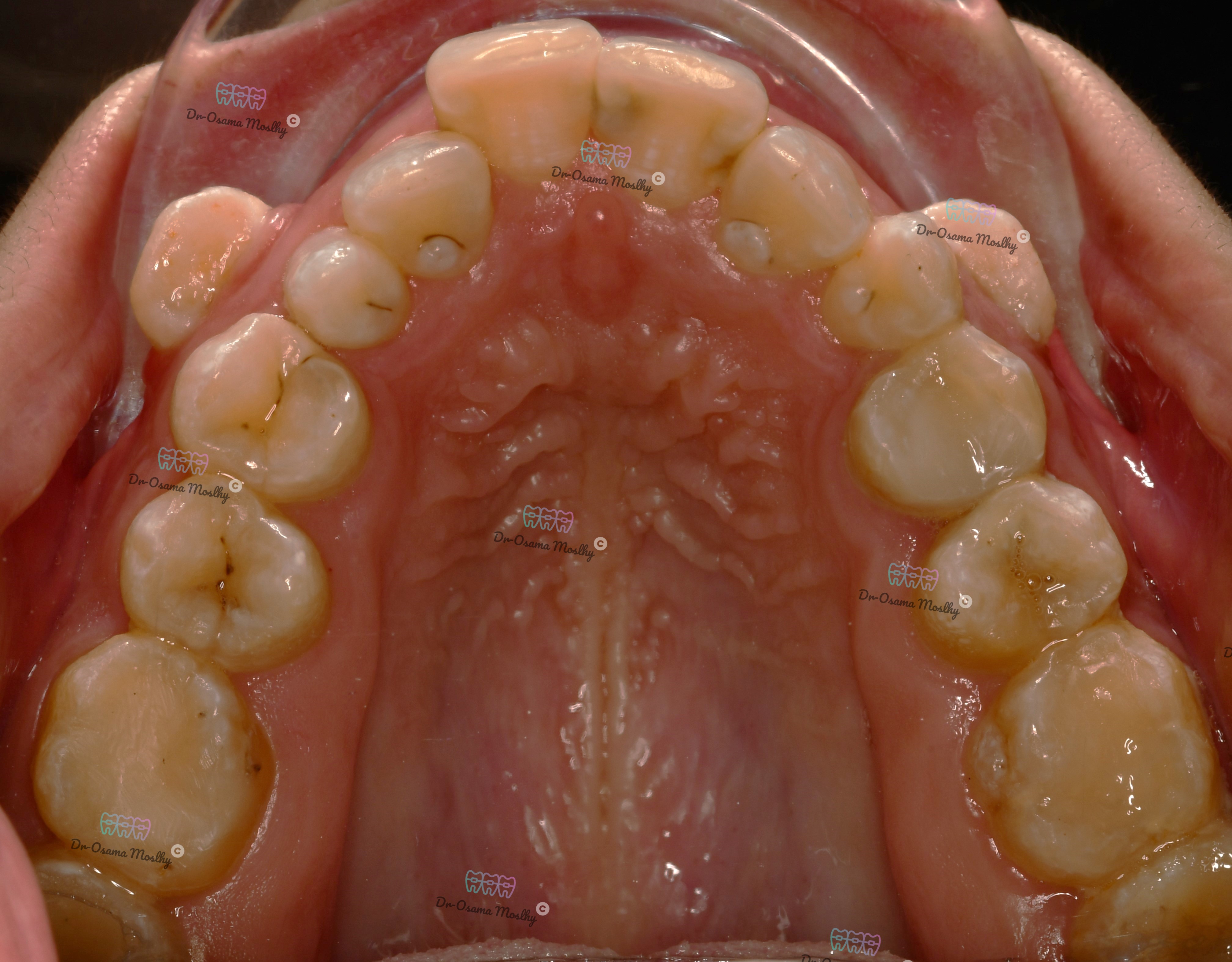 قبل تصحيح أنياب معلقة -Dracula Canine — الفك العلوي — تقويم — تقويم أسنان سموحة