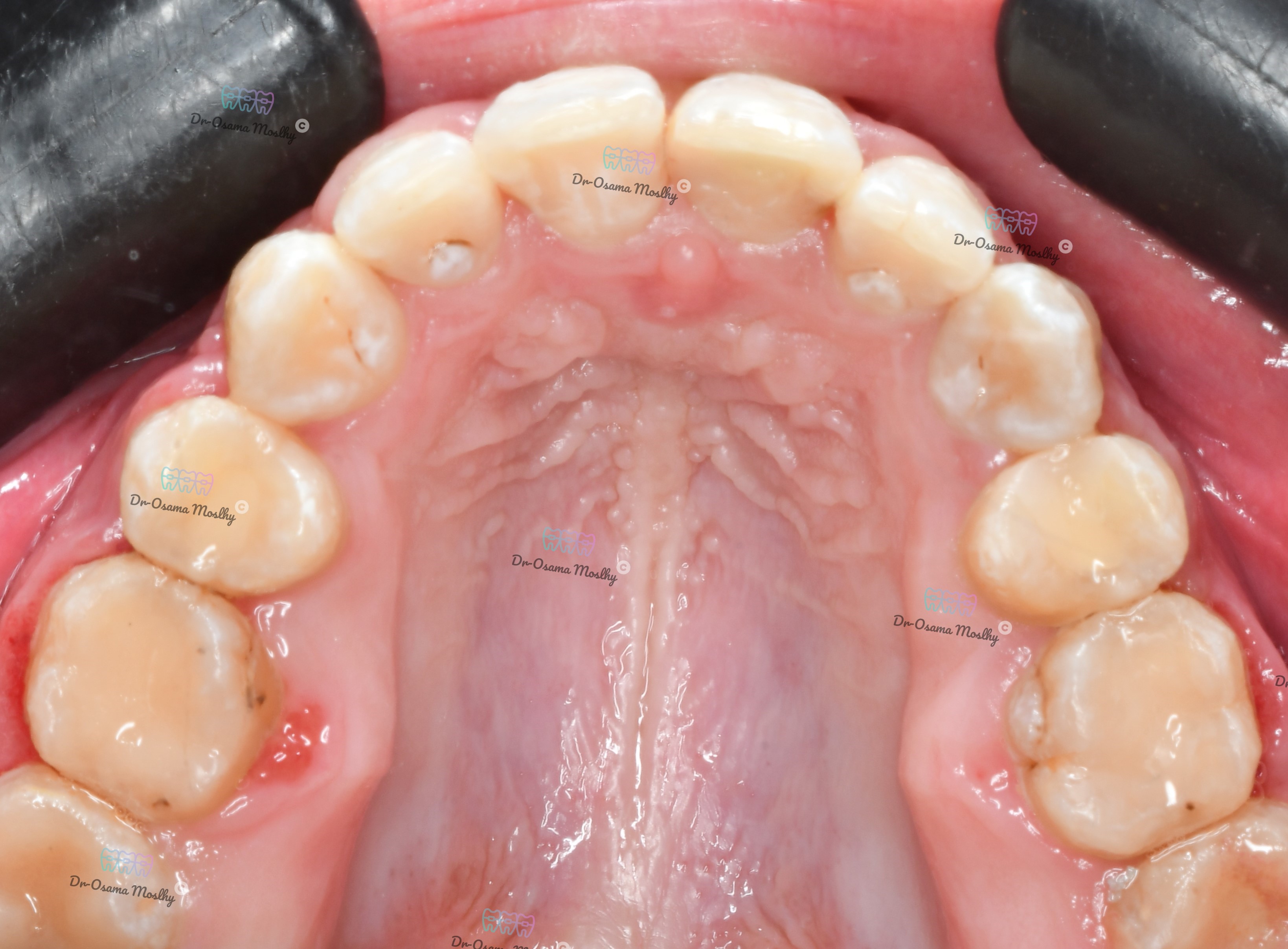 بعد تصحيح أنياب معلقة -Dracula Canine — الفك العلوي — تقويم — تقويم أسنان سموحة