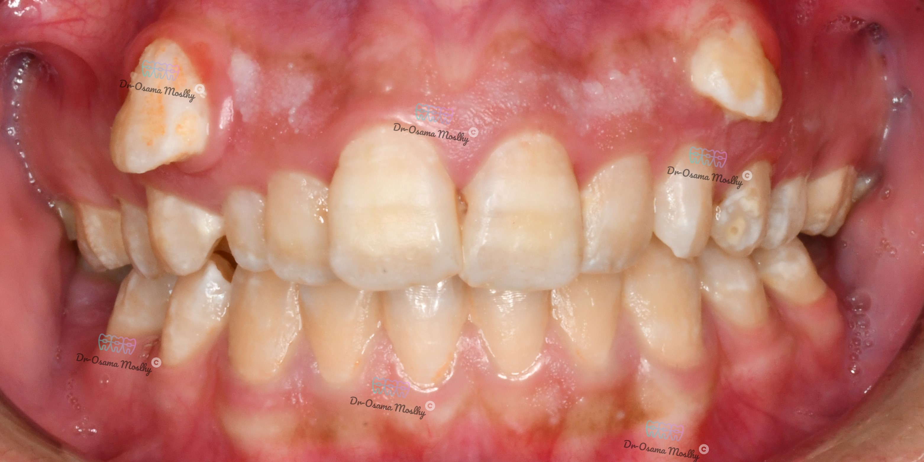 قبل تصحيح أنياب معلقة -Dracula Canine — المنظر الأمامي — تقويم — تقويم أسنان سموحة