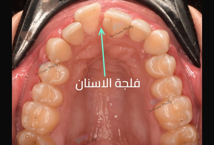 Before علاج فلجة الأسنان العلوية (Midline Diastema) — Upper arch — تقويم — orthodontics Smouha