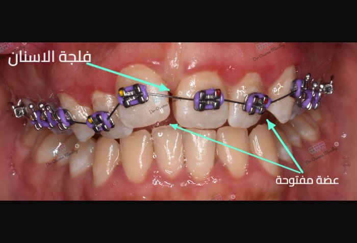Before علاج فلجة الأسنان العلوية (Midline Diastema) — Front view — تقويم — orthodontics Smouha